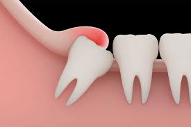 wisdom tooth removal in Gaur City 