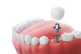 dental implants in Gaur City 