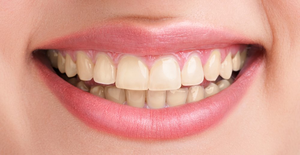 Teeth Whitening Cost in Gaur City 