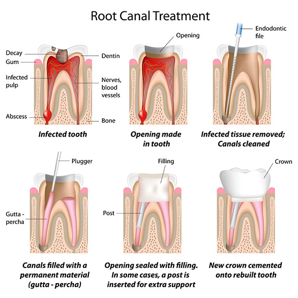 Root Canal Treatment Structure icon