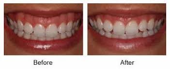 Teeth Re-contouring
